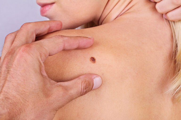 Gender Differences in Skin Cancer Risk: What Every Aussie Should Know