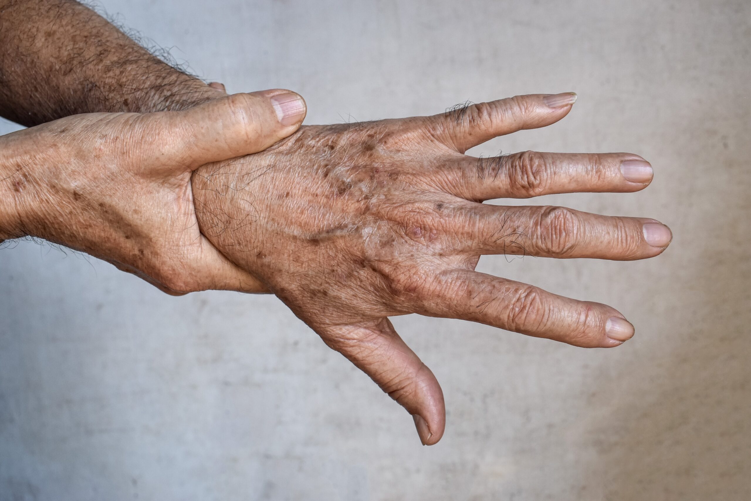 Skin cancer on hands
