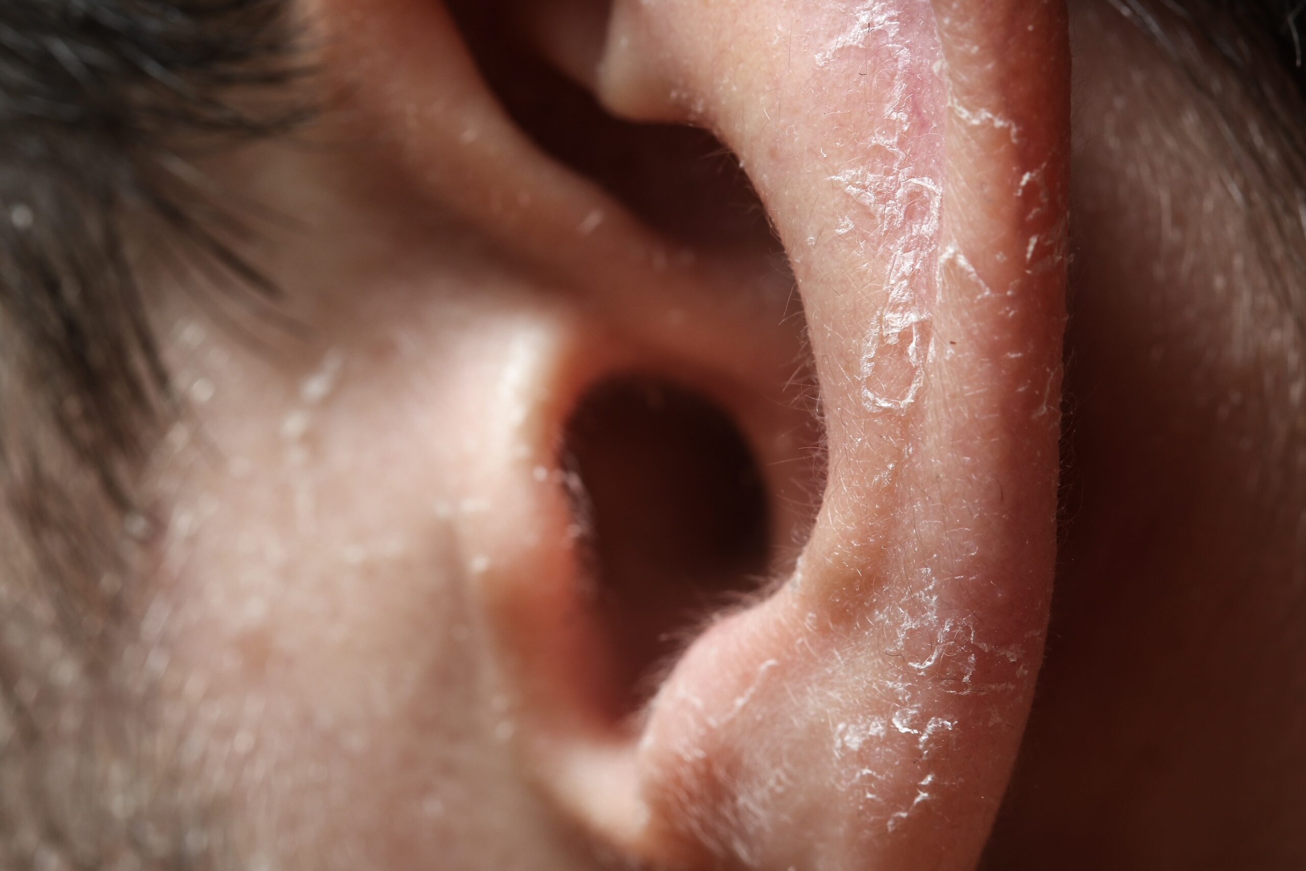 Skin Cancer on Ears: Hidden Danger in WA