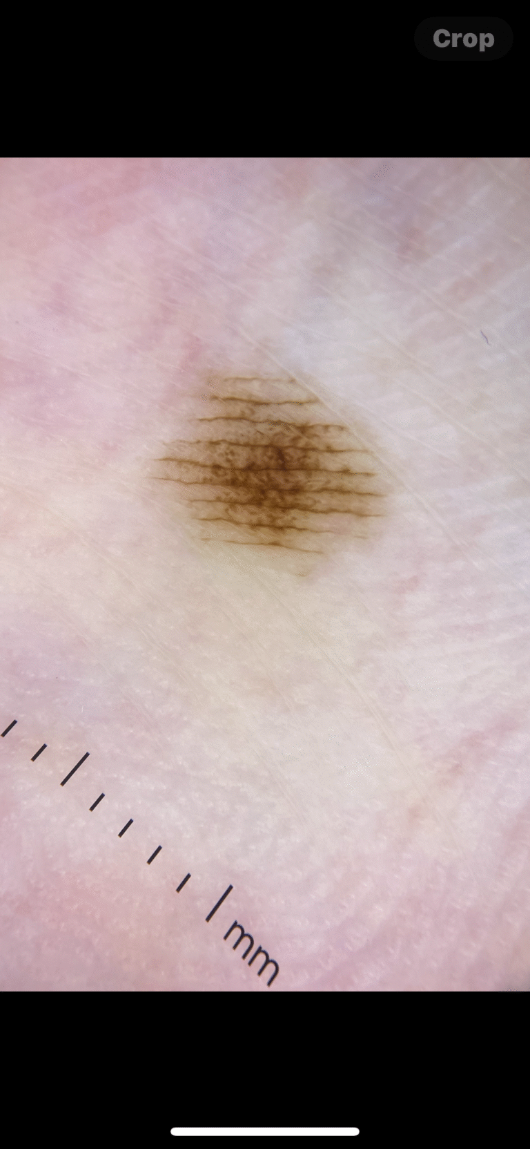 Melanoma on Palms