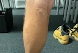 Skin Cancer on the Legs: Why They’re a High-Risk Area in Western Australia