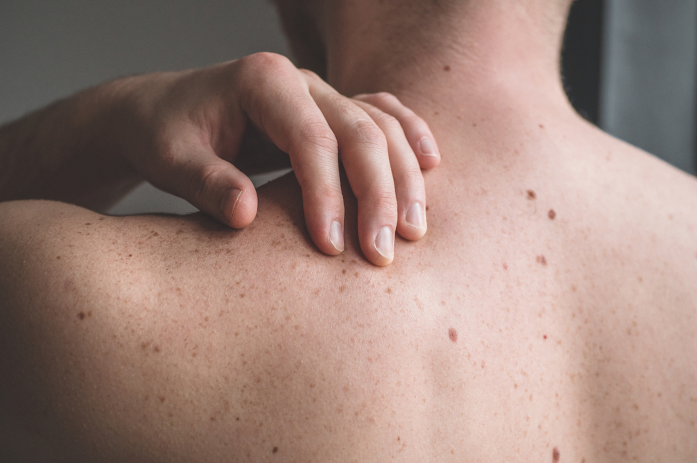 Skin Cancer on the Back: Early Detection with Structured Dermoscopic Assessment
