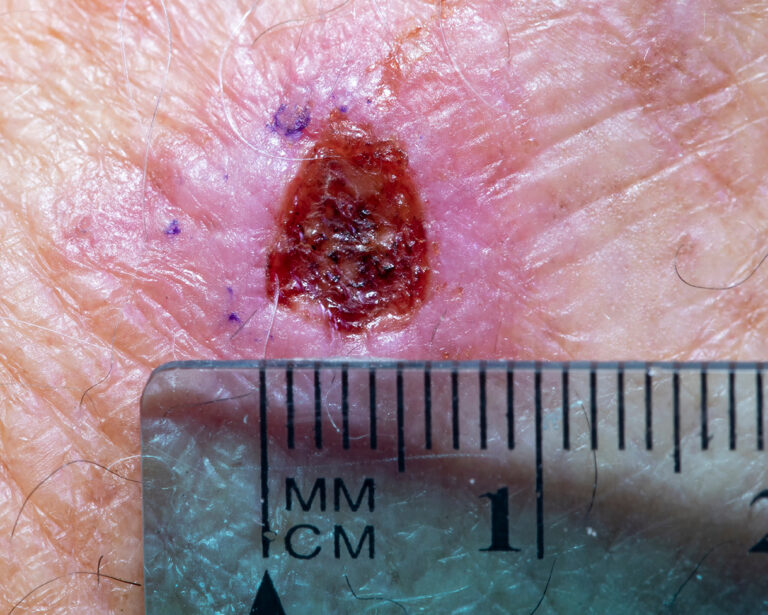 When It’s Not the Sun: Understanding Non-UV Skin Cancers