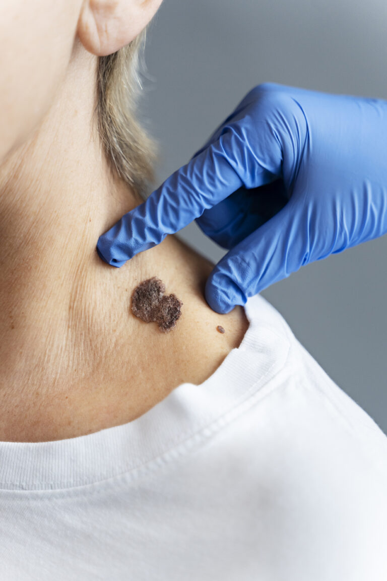 Can Basal Cell Carcinoma Turn Into Melanoma?