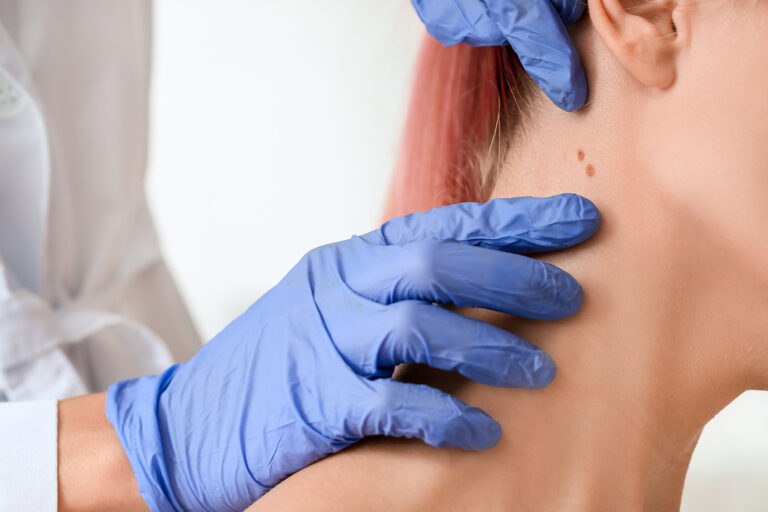 Can skin cancer recur after removal? Learn about recurrence risks, new skin cancers, and why ongoing monitoring is essential after treatment.