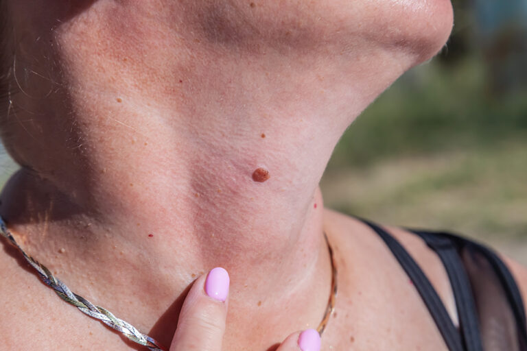 Nodular melanoma grows differently and faster than other melanomas. Learn the warning signs and why early detection is critical.