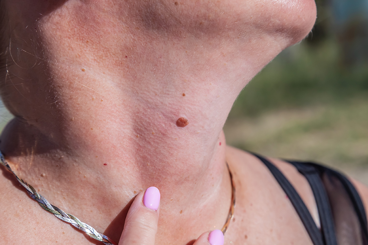 Nodular melanoma grows differently and faster than other melanomas. Learn the warning signs and why early detection is critical.